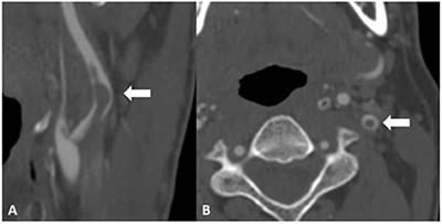 Natural history of carotid artery free-floating thrombus—A single center, consecutive cohort analysis